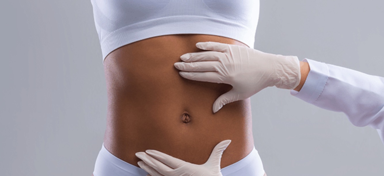 liposection