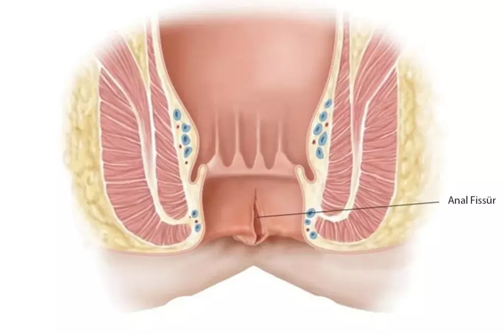 anal-fissur